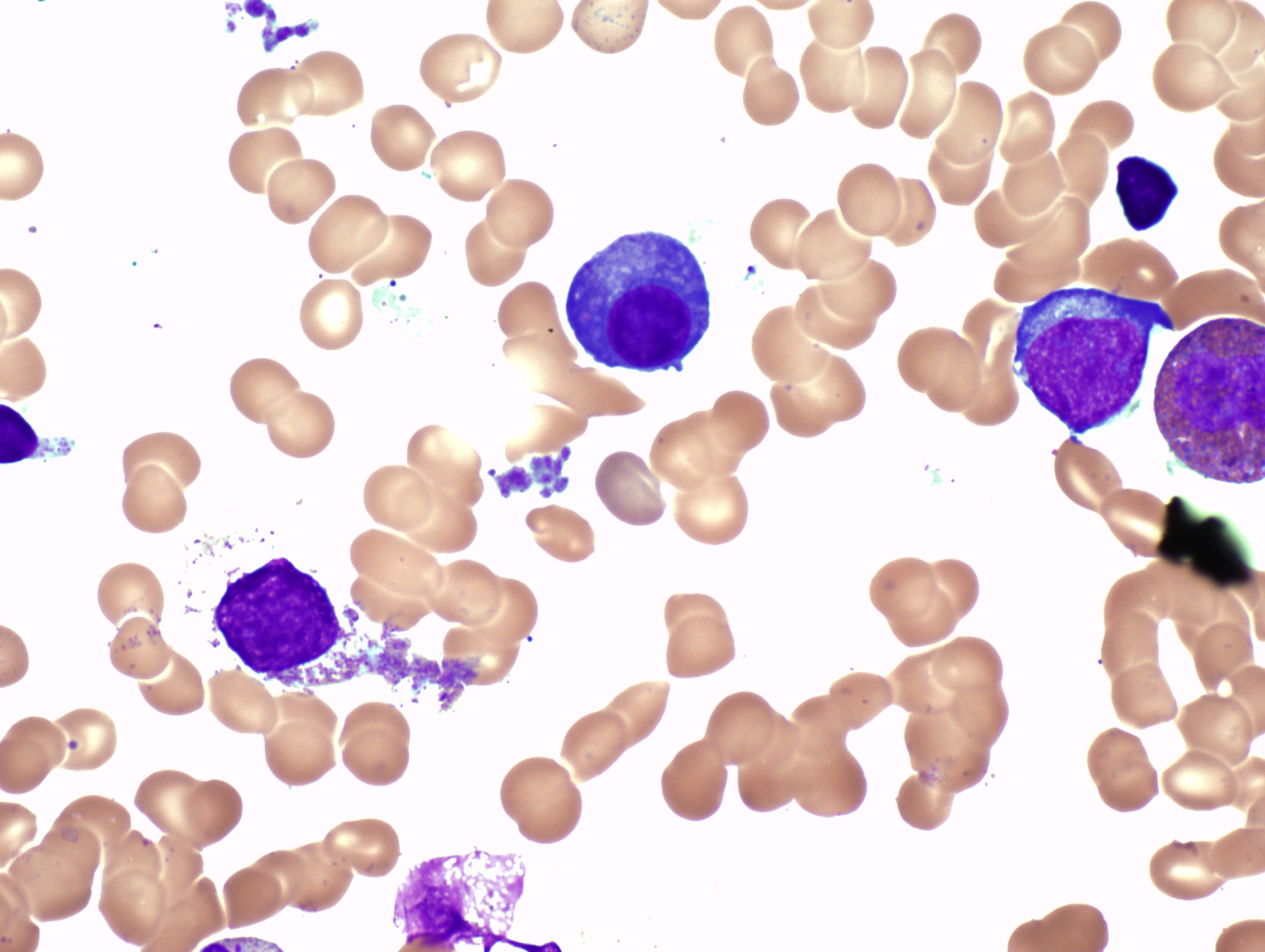 Blood cells cancer
