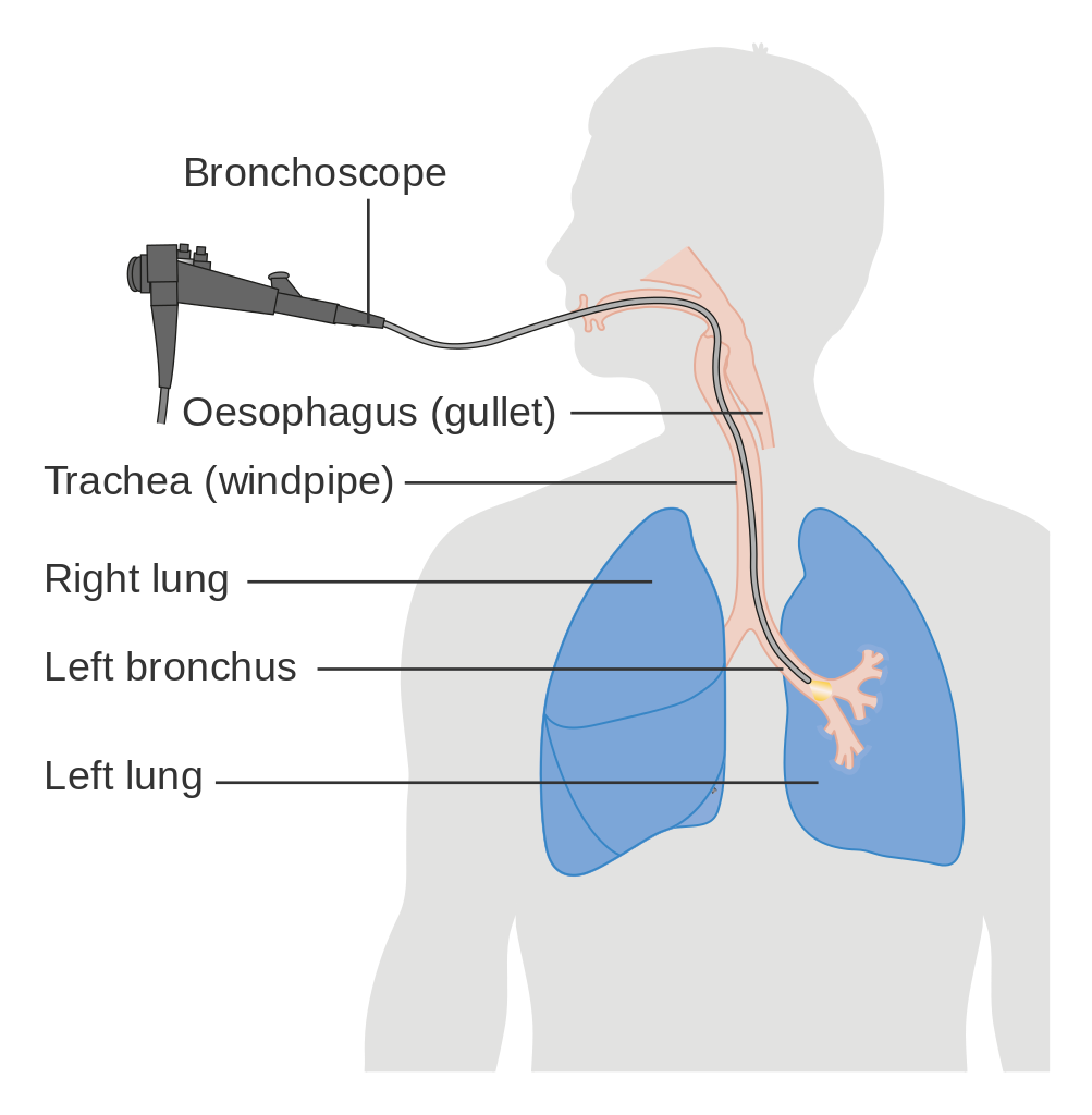 Illustrated diagram showing a bronchoscopy procedure