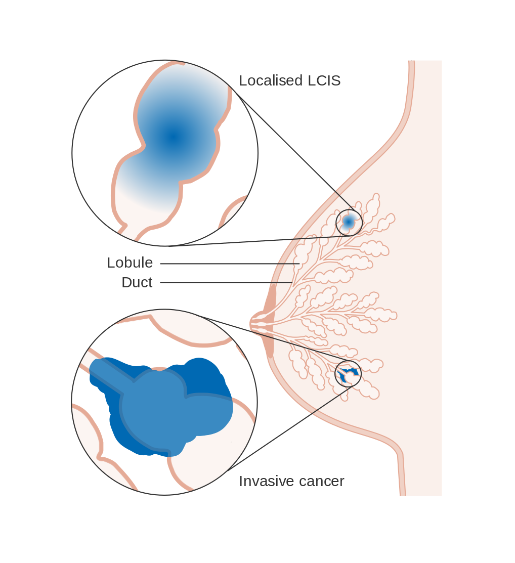 Diagram of LCIS - lobular carcinoma in situ