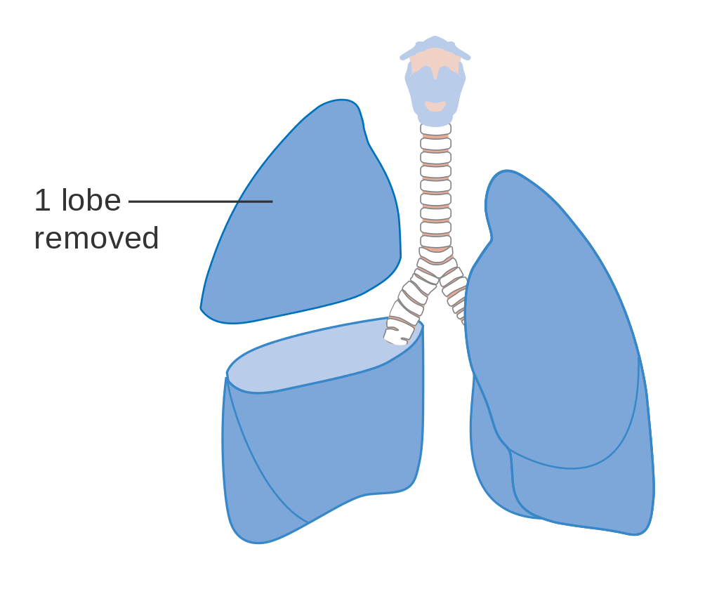 lobectomy lung