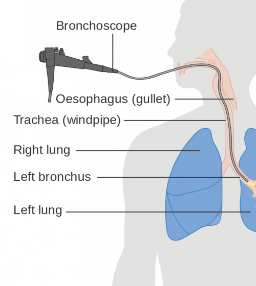 Illustrated diagram showing a bronchoscopy procedure