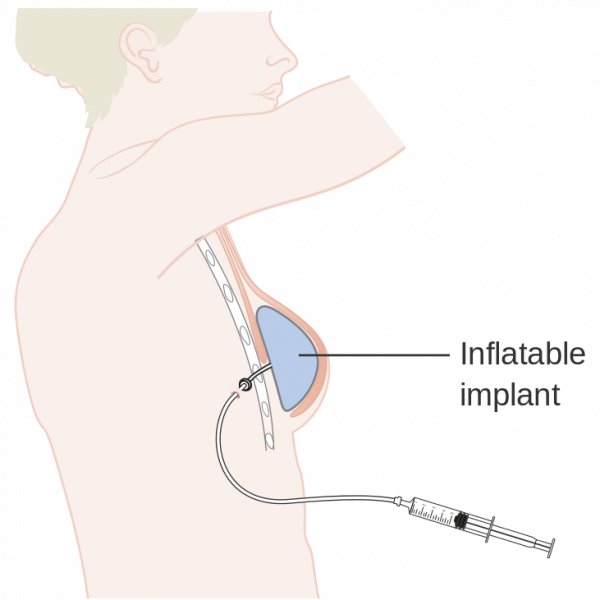 Inflatable breast implant