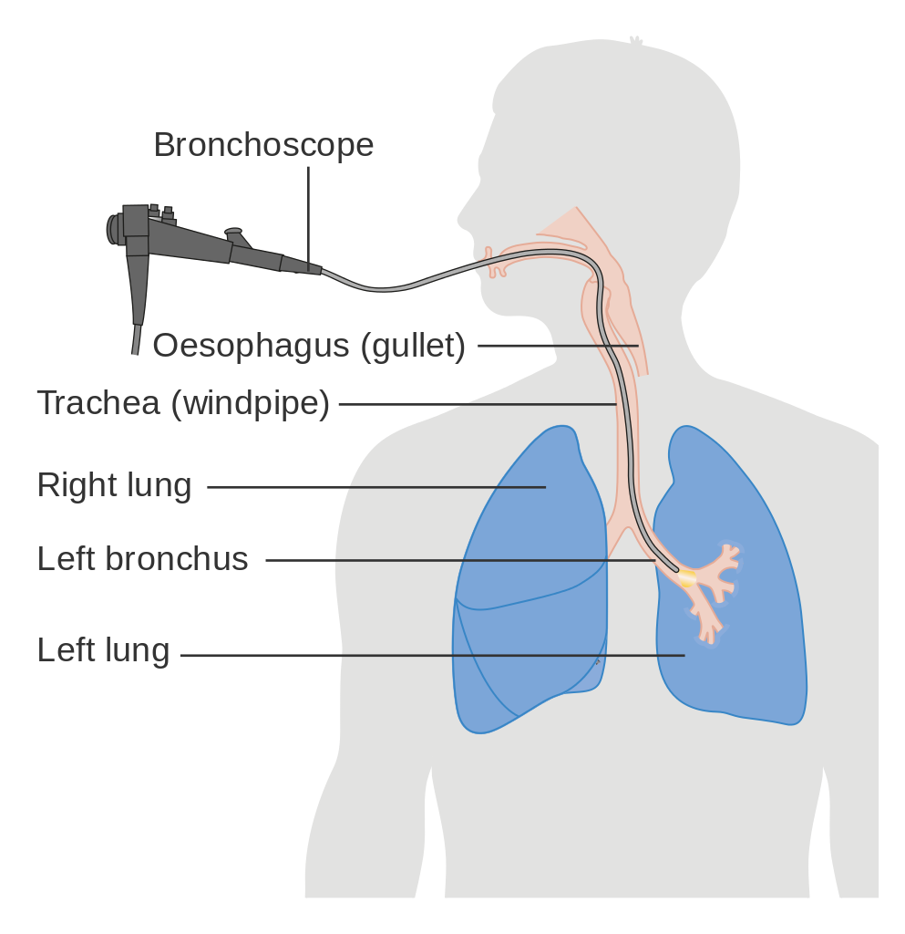Illustrated diagram showing a bronchoscopy procedure