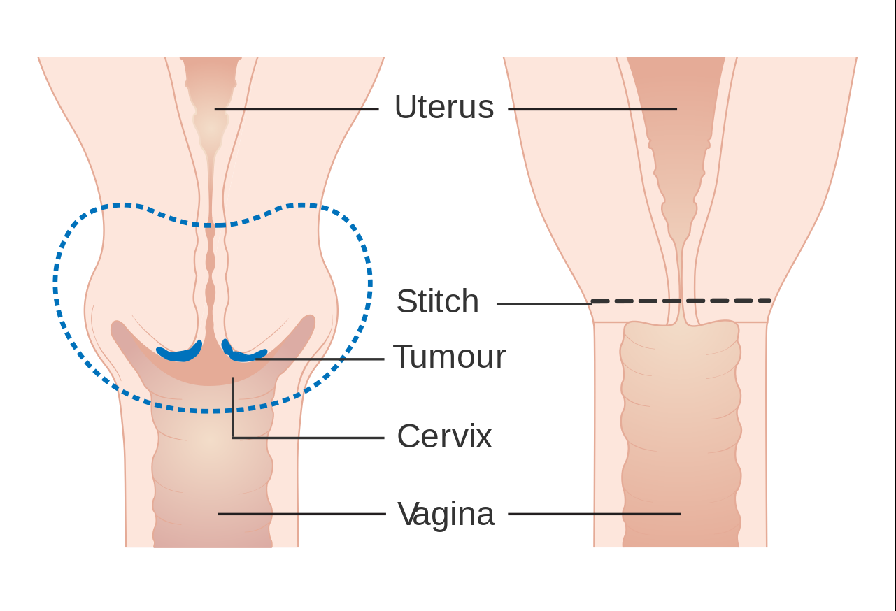 trachelectomy_surgery
