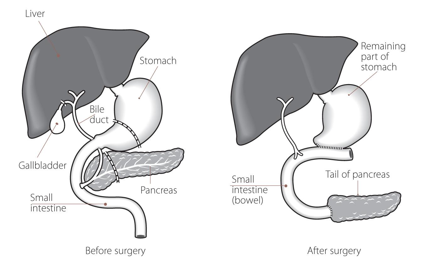 Whipple pancreas