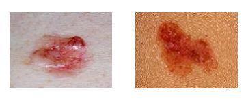 Basal cell cancer