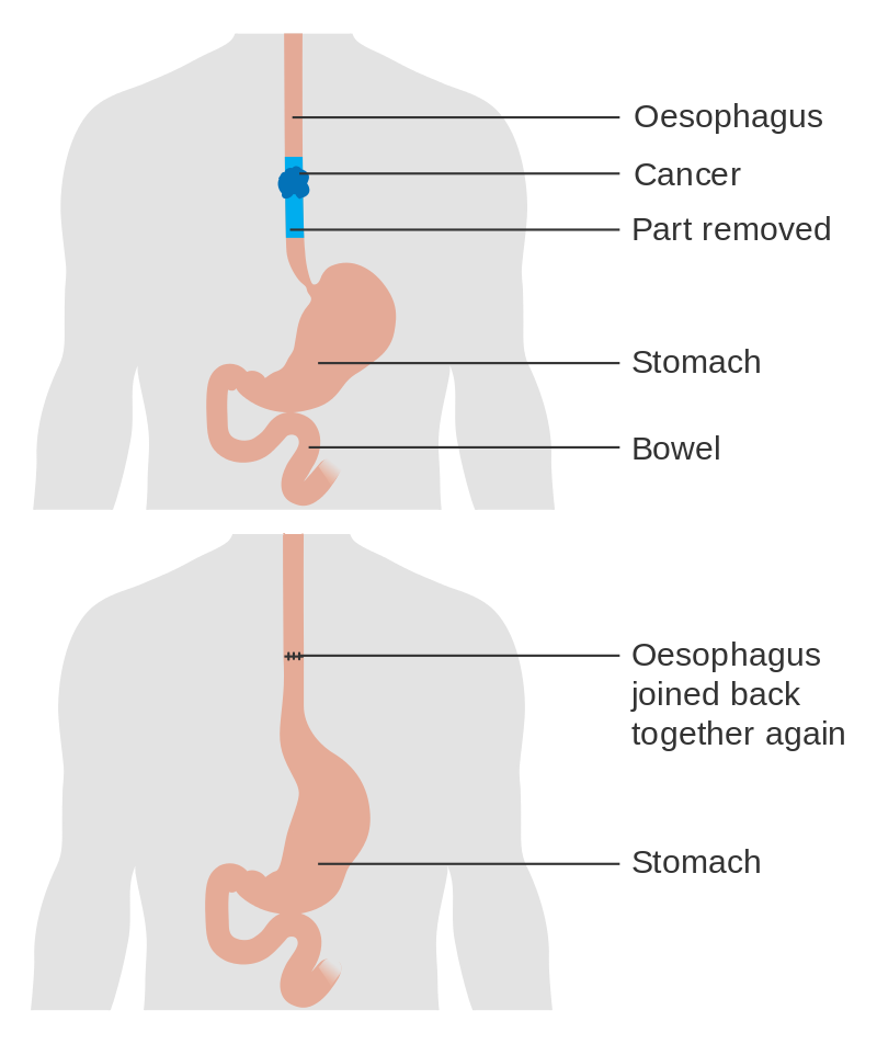 Oesophagectomy (Image courtesy of Cancer Research UK / Wikimedia Commons)