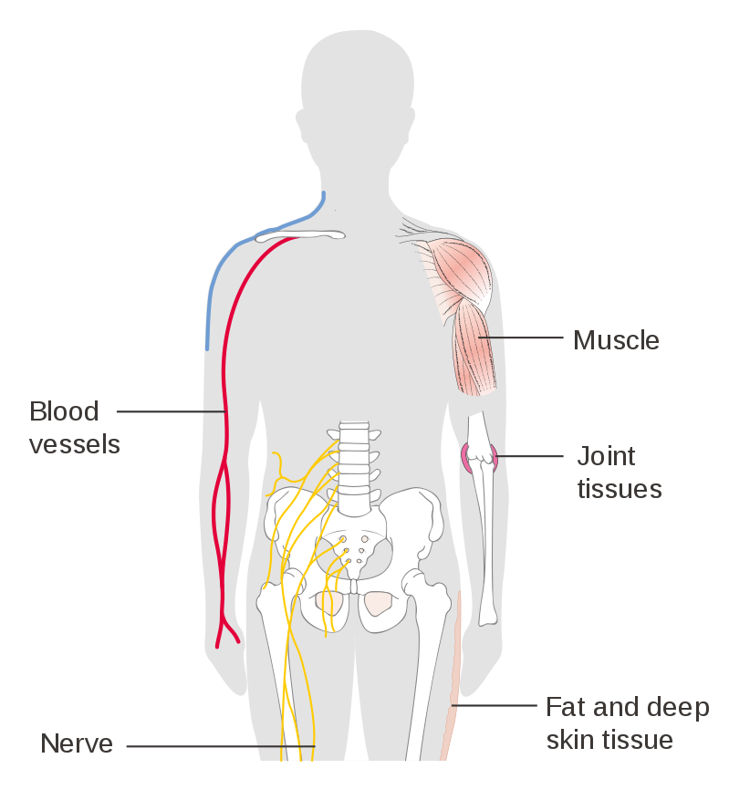 Sarcoma