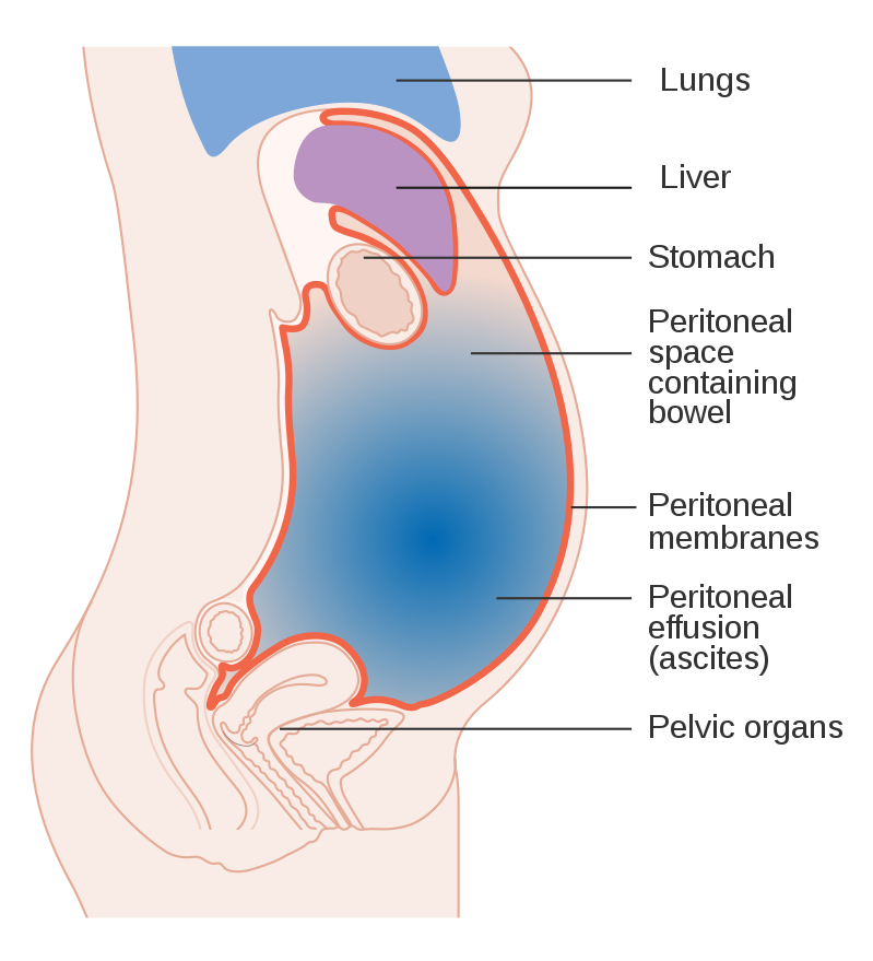 Ascites (Fluid build-up in the tummy)