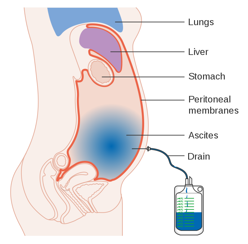 DIagram showing a cross section of a tummy with a build-up of fluid (ascites) being drained into a bag through a needle.