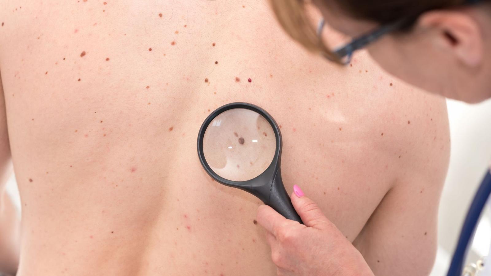 Doctor examining moles