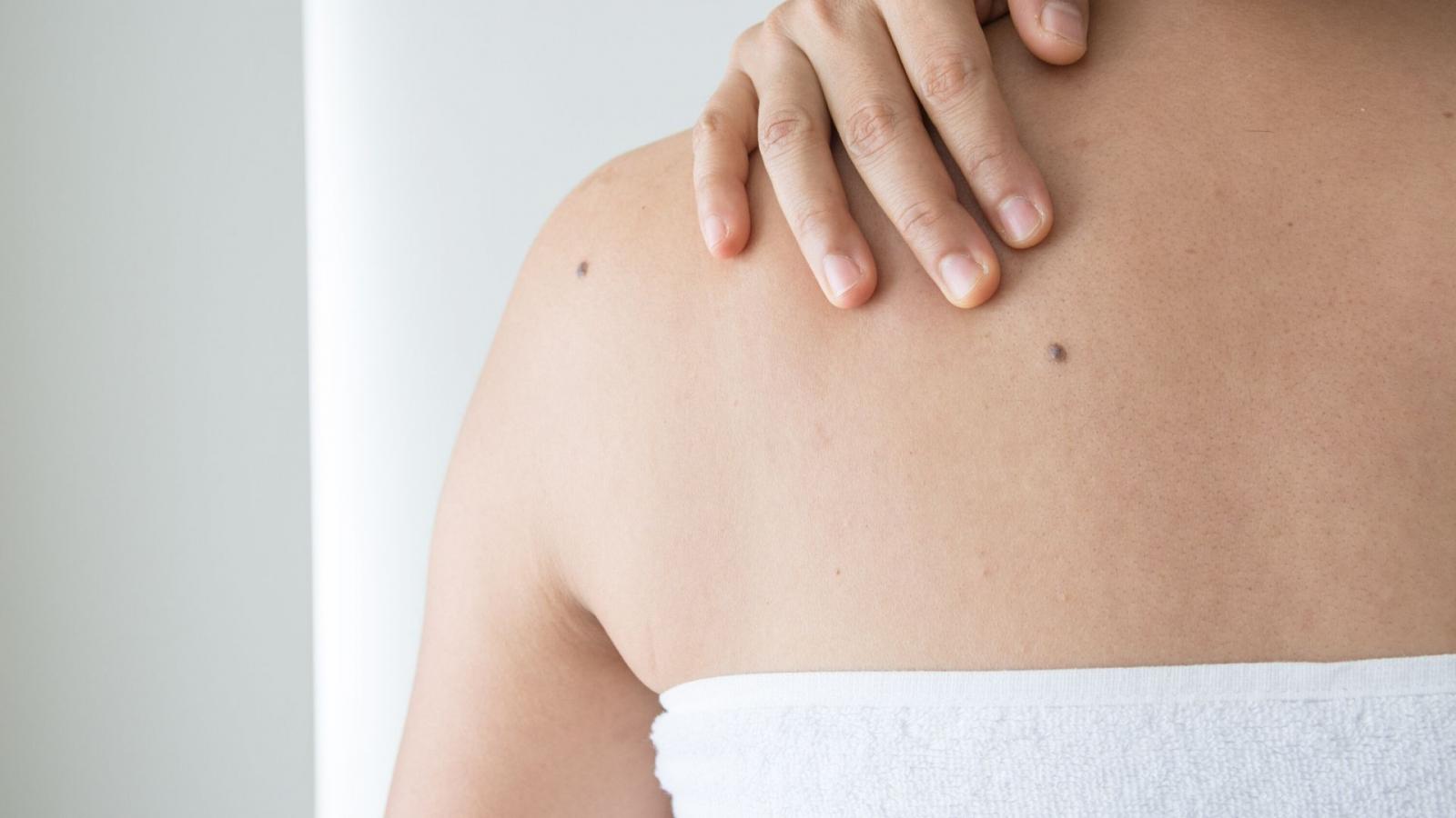 Woman with moles