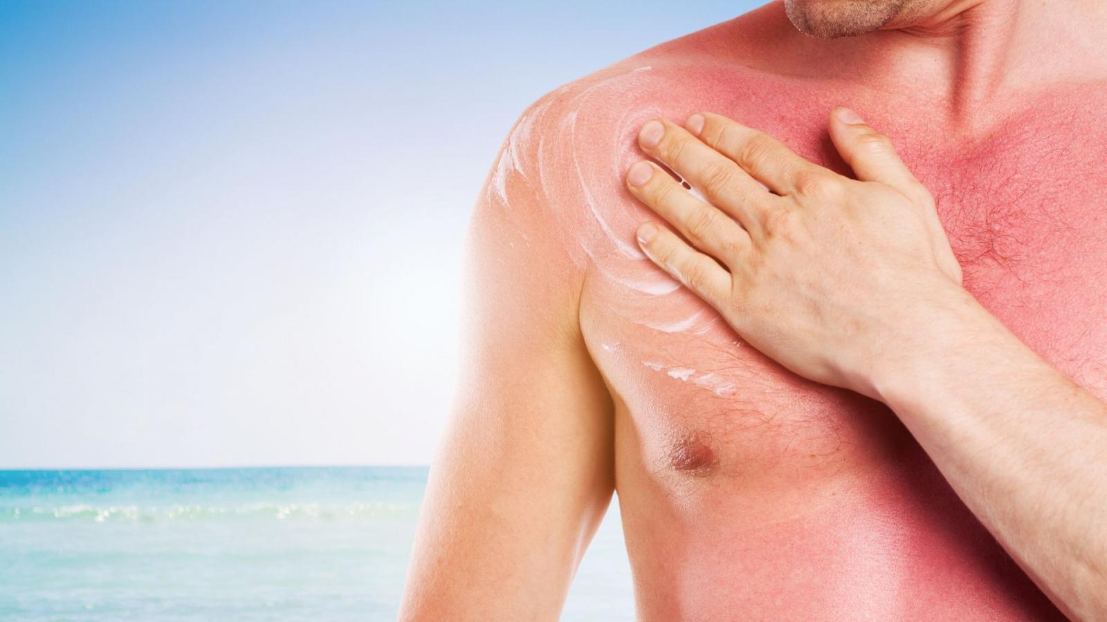 Sunburn