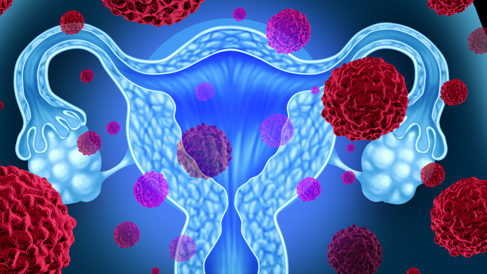 womb cancer diagram